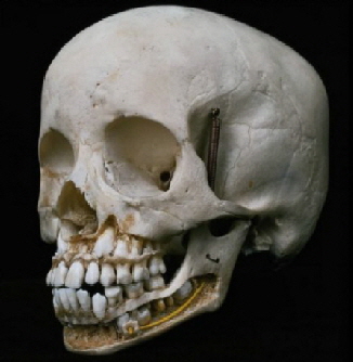 Schdelknochen
